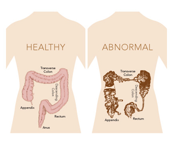 Intestine Swelling